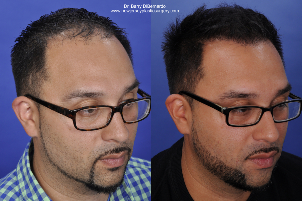 Before and after from Dr. DiBernardo