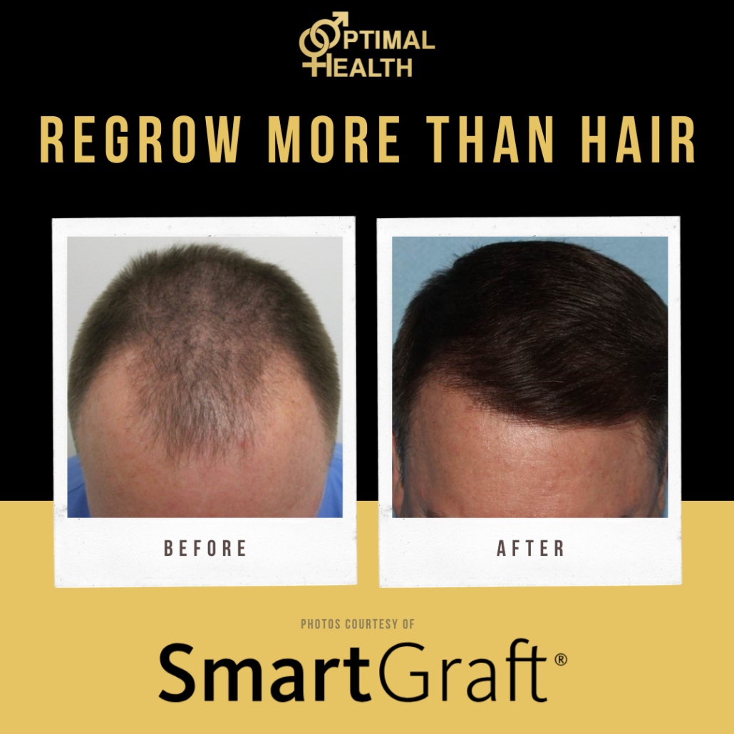 Before and after of hair transplant
